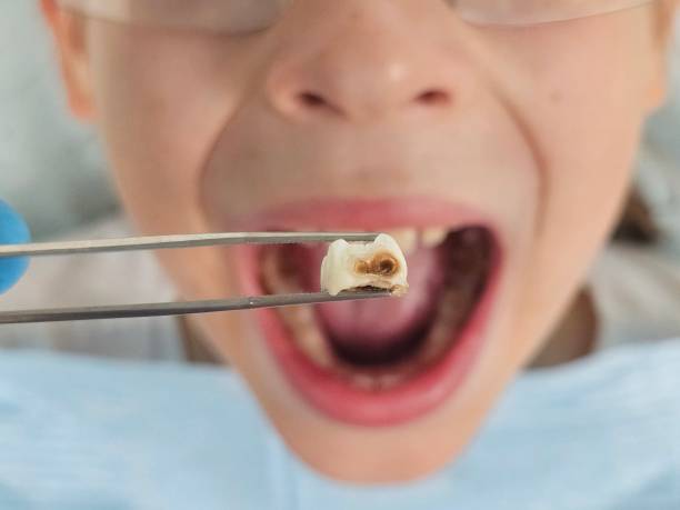Best Urgent Tooth Repair  in Lula, GA